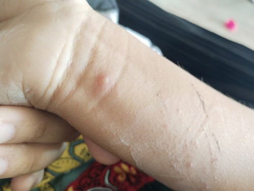 อาการเเพ้ยา