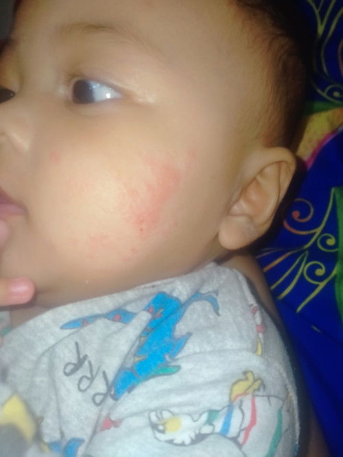 Ruam pipi bayi 4 bulan