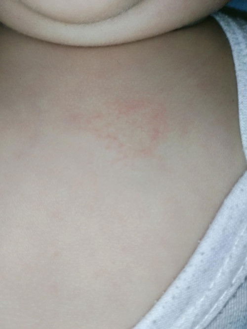 Ointment for Ringworm