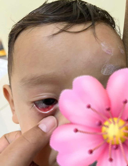 MATA BINTITAN BABY 1tahun