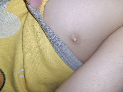 Benjolan putih dekat puting anak