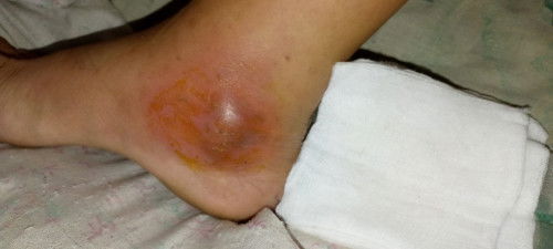 Taking folic acid/calcuimade/hemarate iron+multivitamins and also cefuroxime at saka paracetamol