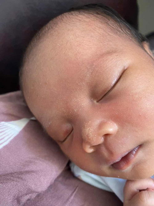 Bintik putih di hidung