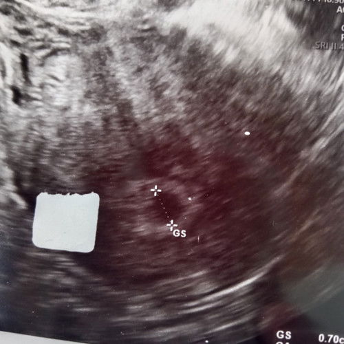 Selesai haid  tapi langsung garis dua