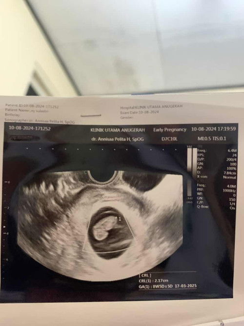 Janin umur 9 weeks blm terdeteksi detak jantungnya