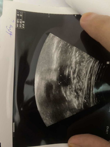 Penyakit cyst