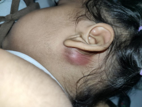 อยู่ๆน้องก็บ่นเจ็บหลังหู