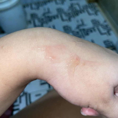 Jelly-like discharge.