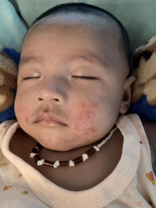 แม่ๆบ้านไหนลูกเคยเป็นแบบนี้บ้างค่ะขอคำแนะนำหน่อยค่ะใช้อะไรให้หายขาดหาหมอแล้วก็ยังไม่หายค่ะ