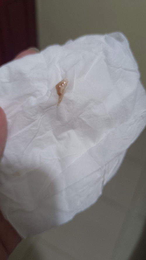 Flek kecoklatan usia 22w