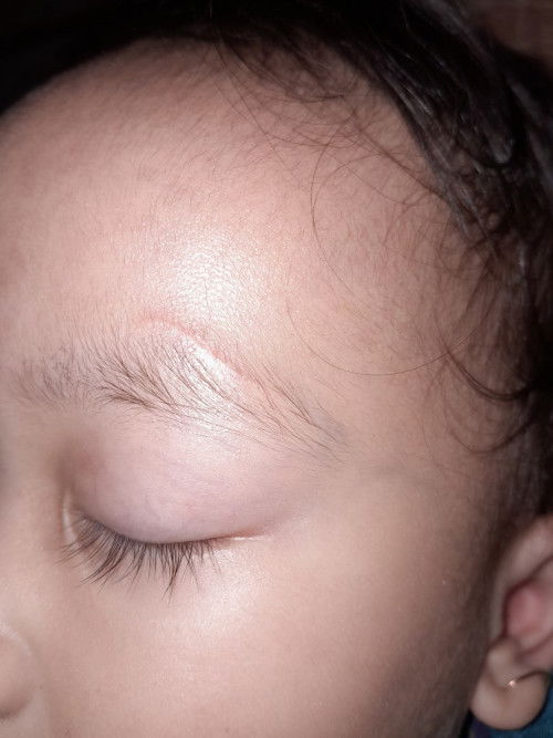 Sharing bekas luka robek diwajah