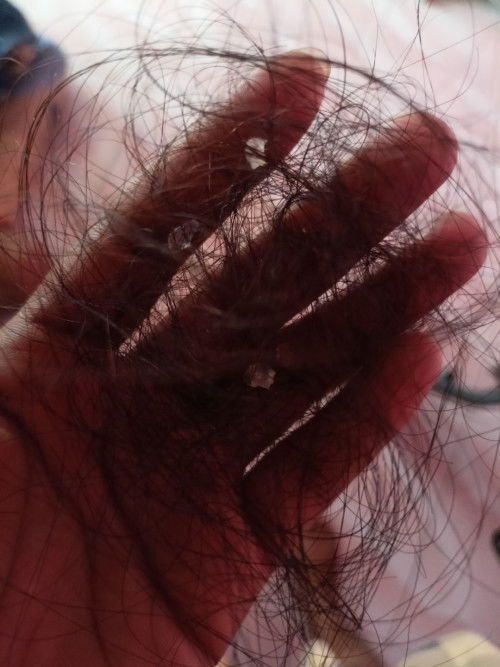 Rambut rontok saat menyusui