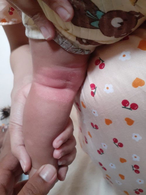 Ruam di lipatan belakang lutut