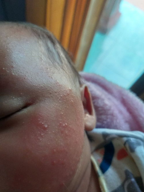 Hallo bunda2.. saran dong cream buat bruntusan adik di wajah.. mungkin ada yg ngalamin juga ndak??