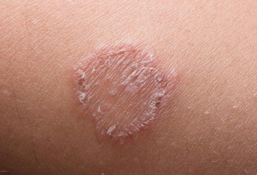 Ringworm baby
