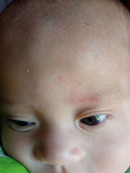 Itu d katakan alergi apa bukan soalnya mau k DSA jauh belum ada yang anter