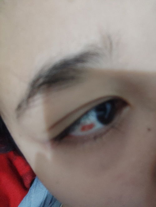 Hay bund, mau tanya, hamil 11 minggu dimata ada merah seperti ini. Ini kenapa ya? Emng dari hamil