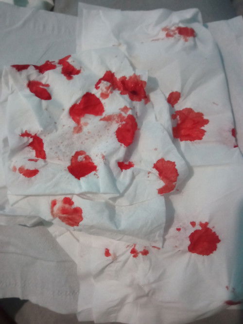 Hamil sering mimisan