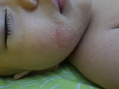 Ruam pada pipi bayi umur 10 bulan