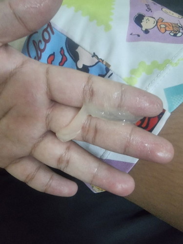 อันนี้คือ มูกใส หรือ ตกขาว