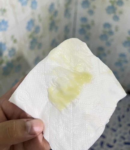 ตกขาวแบบนี้ปกติไหมค่ะ