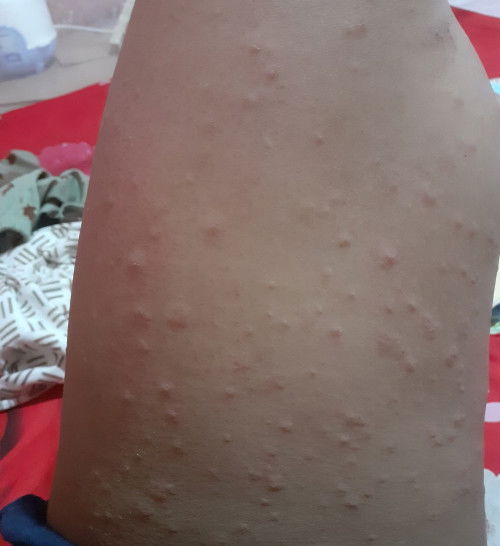 bun apa ini alergi ya,udh dksih obat , salep ttp aja gk smbuh2 udh 3 hrian, klo ad yg prnh ngalamin