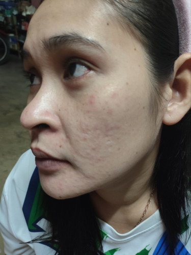 ใบหน้าขึ้นผื่นเเดง