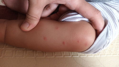 Bayi kena kutu kasur