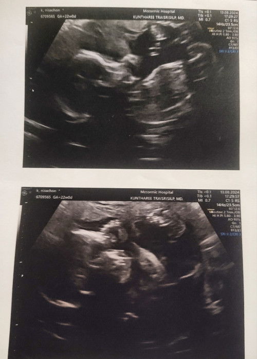 อัลตร้าซาวด์MFM หมอกดด้วยเครื่องซาวแล้วเจ็บท้อง