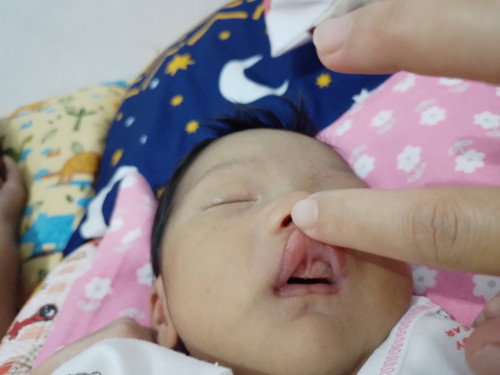 Apa ini Lip Tie?