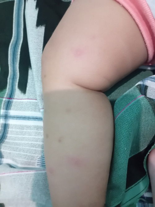 Bintik merah bekasnya hitam