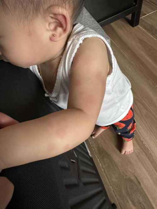 Round Red Skin Patches / Rashes