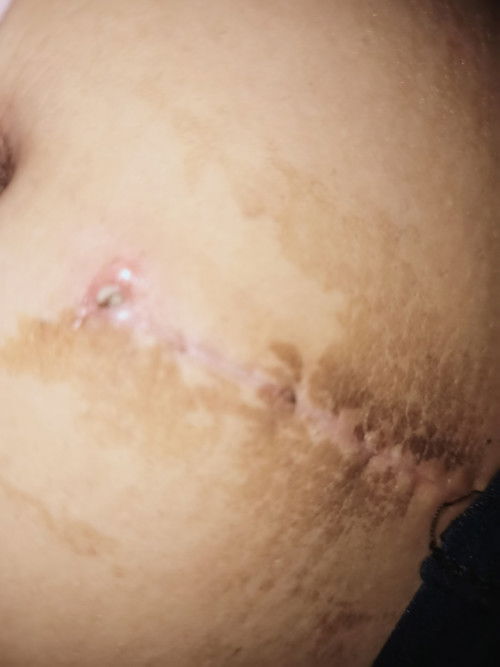 Nagnana ang tahi ng cs