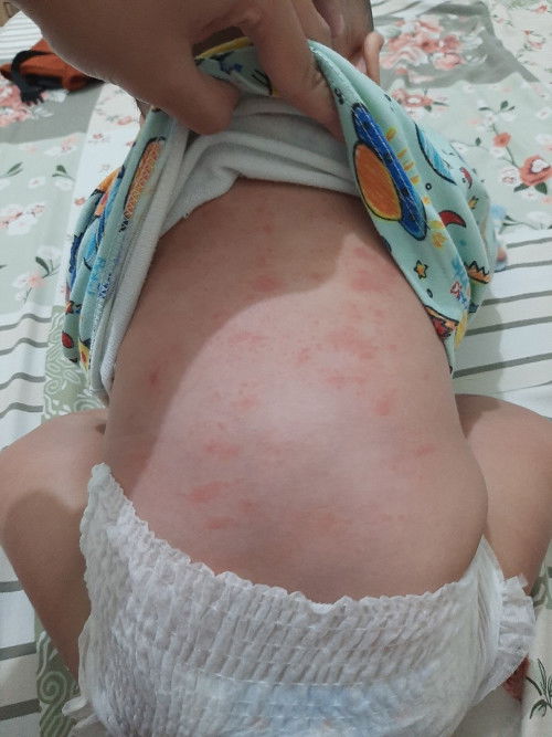 Ruam di punggung bayi