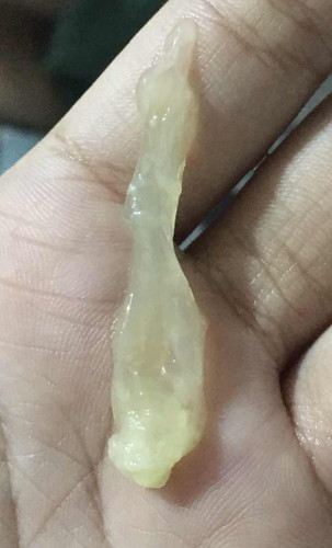 Vaginal Discharge!