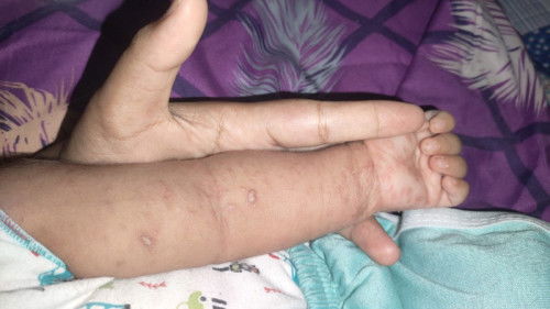 Gatal gatal di seluruh tubuh