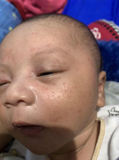 muka bruntusan pada newborn