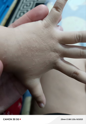 Butlig sa kamay
