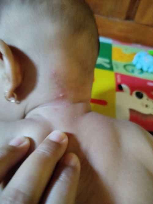 Bruntus d sertai nanah