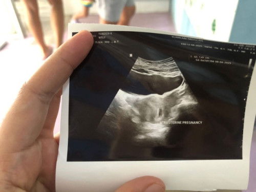 Hello ada mumy yg berpengalaman mngandung tp Intrauterine pregnancy ka?bru usia kandungan dh 5mngu