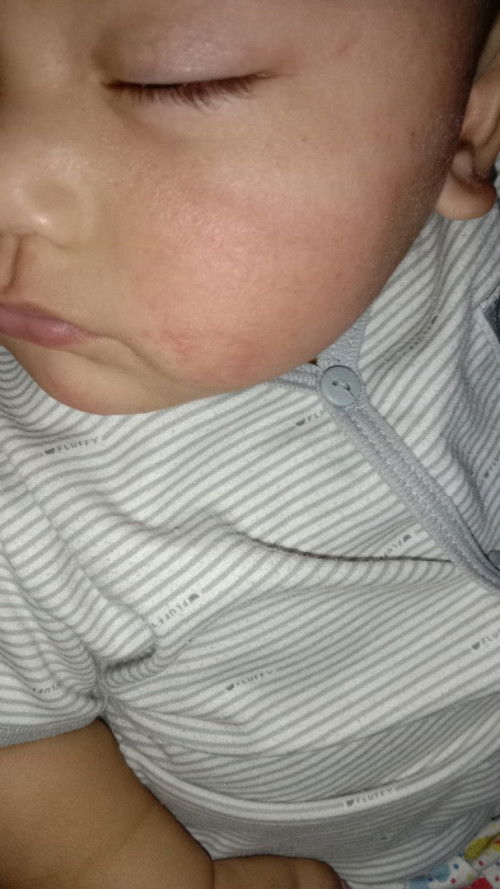Penyebab wajah bayi merah2
