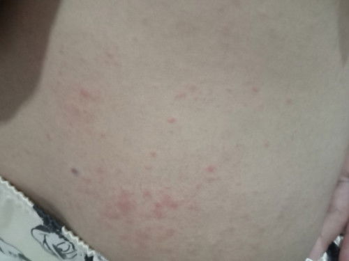 ท้องได้2เดือนผื่นคันแเดงขึ้นเต็มตัวเลยค่ะแม่ๆท่านใหนเป็นบ้างค่ะ
อันตลายใหมค่ะต้องรักษายังไงค่ะ