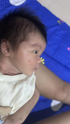 หน้าลูกเป็นแบบนี้ ต้องใช้ยาตัวไหนค่ะ