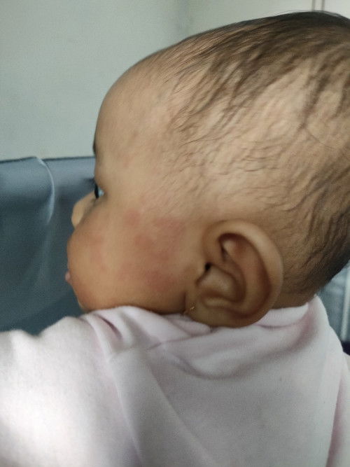 Bentol2 merah sebadan 🥲