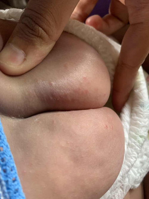 ผืนแดงที่ก้นของลูกน้อย