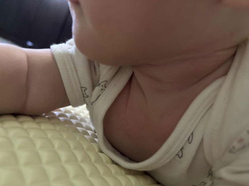 รอยแดงแบบนี้?