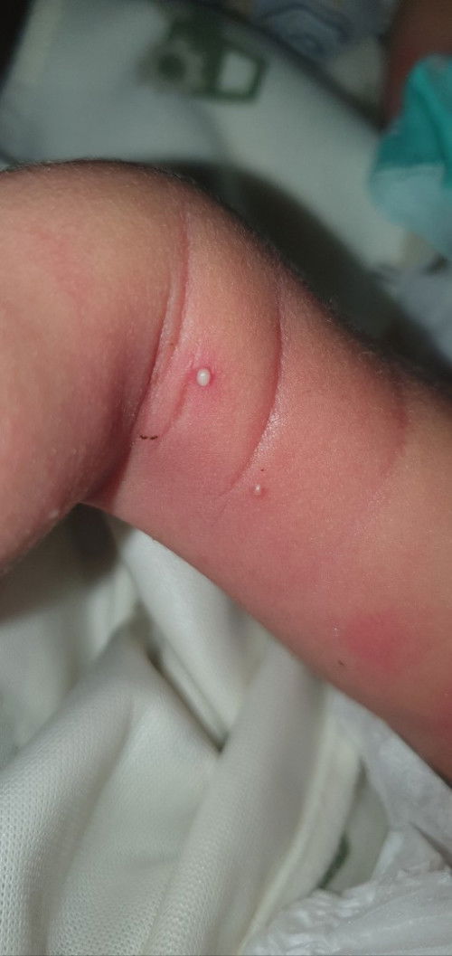 Muncul bintik bintik