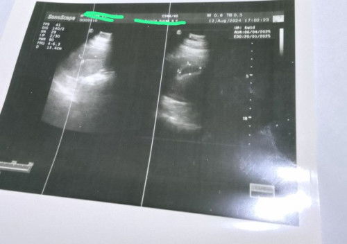 USG 6week 1day baru kantong hamil?