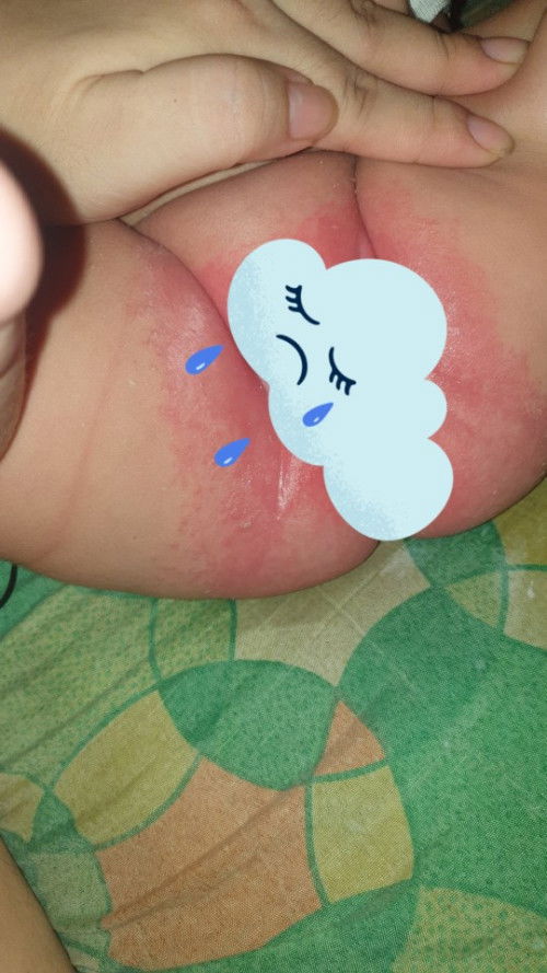 DIAPER RASHES