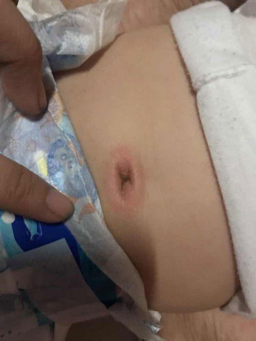 Normal lang po ba tong pusod ni baby?